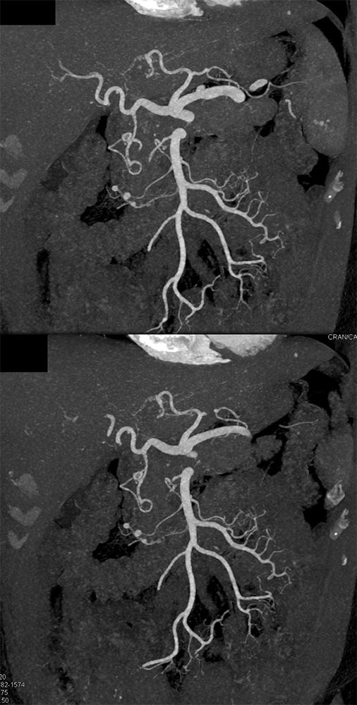 PAN (Polyarteritis Nodosa)