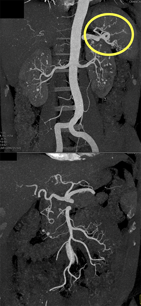 PAN (Polyarteritis Nodosa)