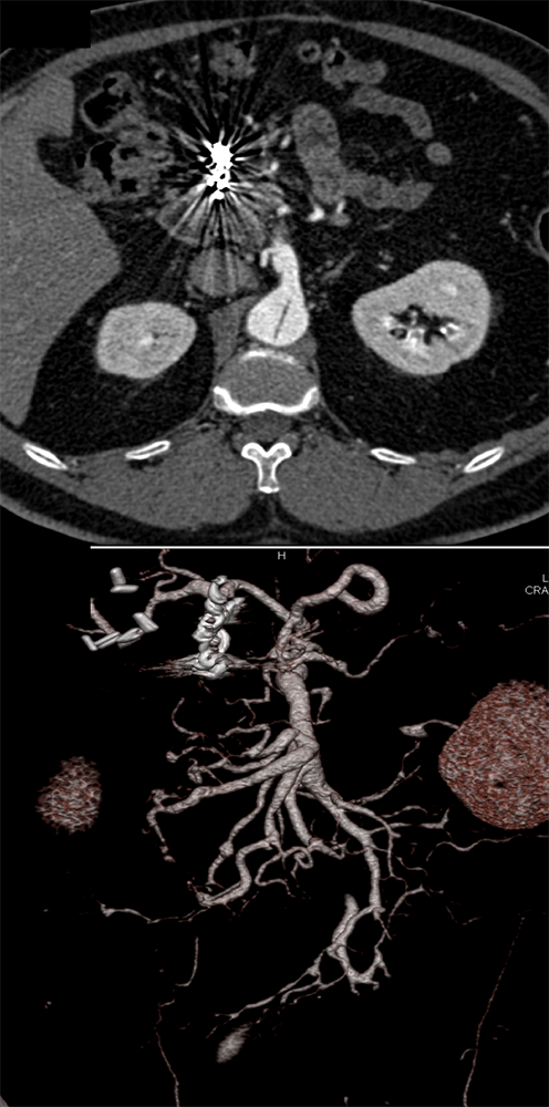 Polyarteritis Nodosa with Involvement SMA and Celiac