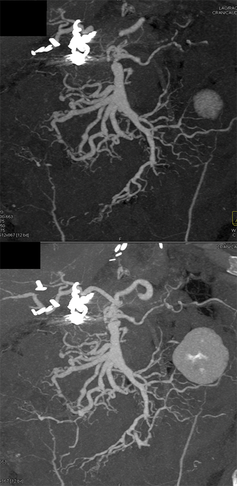 Polyarteritis Nodosa with Involvement SMA and Celiac