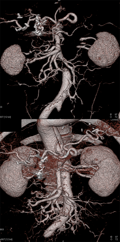 Polyarteritis Nodosa with Involvement SMA and Celiac