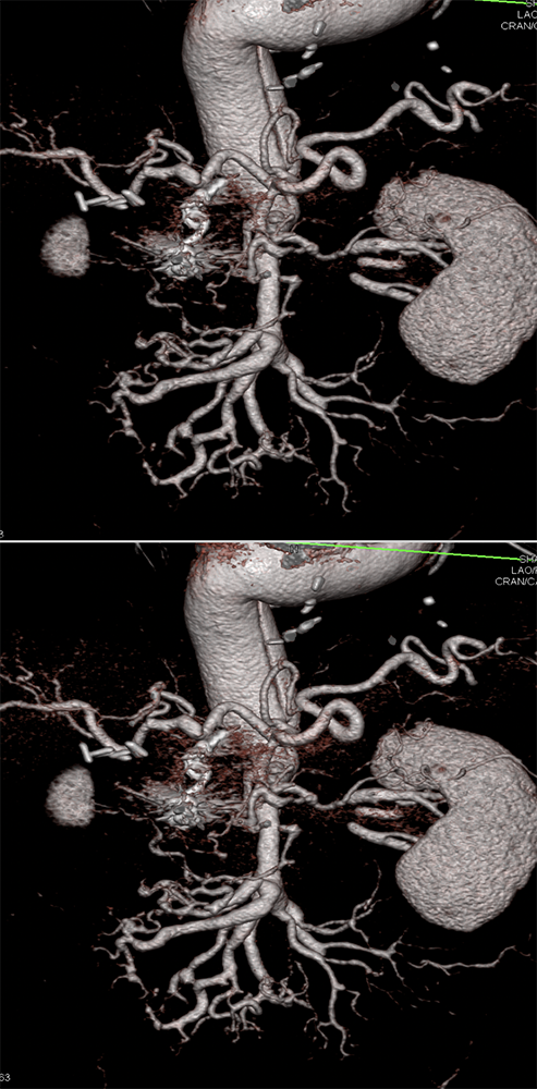 Polyarteritis Nodosa with Involvement SMA and Celiac