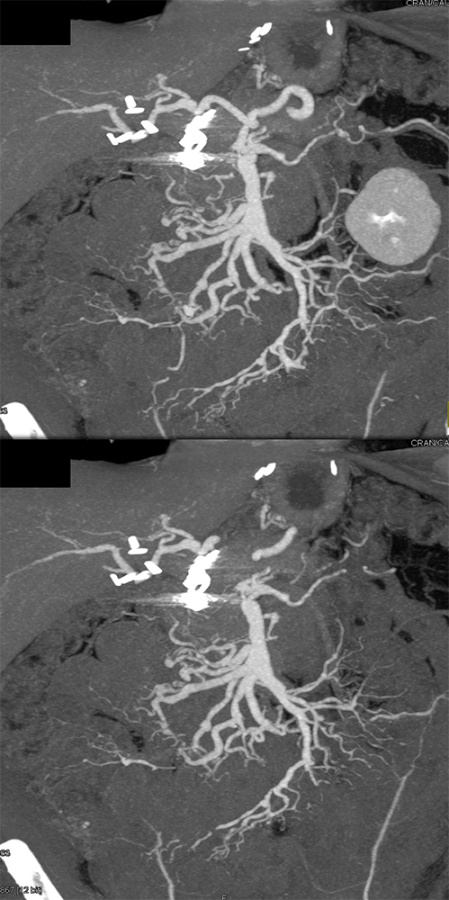 Polyarteritis Nodosa with Involvement SMA and Celiac