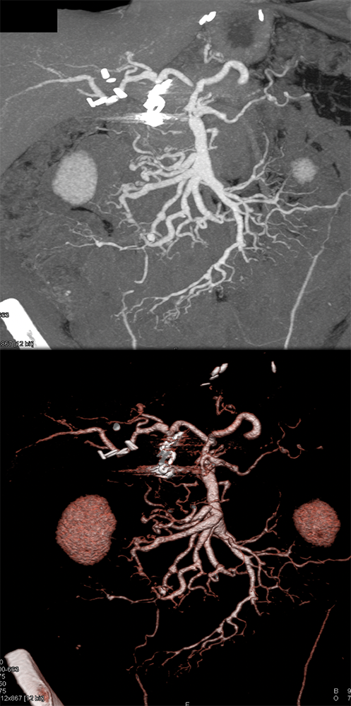 Polyarteritis Nodosa with Involvement SMA and Celiac