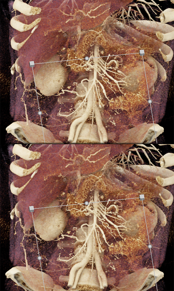 Polyarteritis Nodosa and SMA Branch Involvement