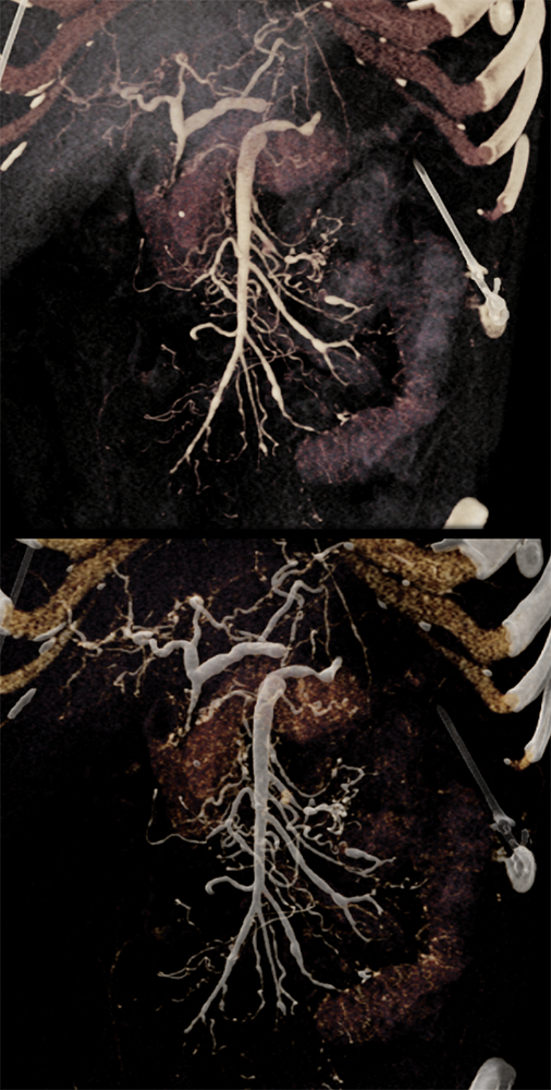 Polyarteritis Nodosa and SMA Branch Involvement