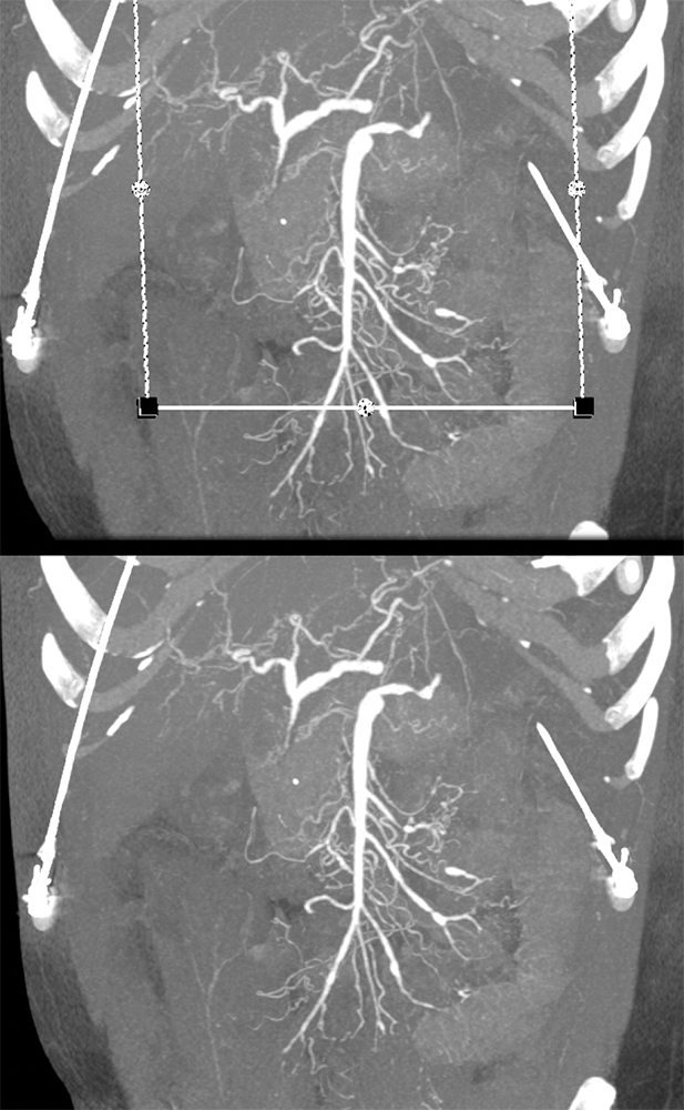 Polyarteritis Nodosa and SMA Branch Involvement