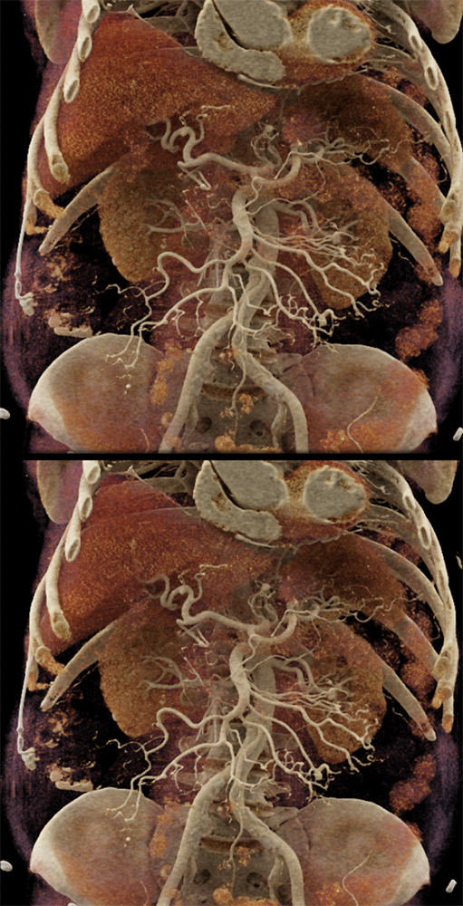 Polyarteritis Nodosa: Vasculitis SMA and Celiac