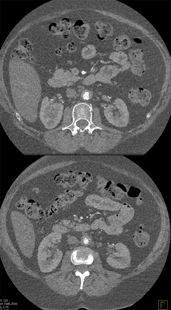 Giant Cell Arteritis