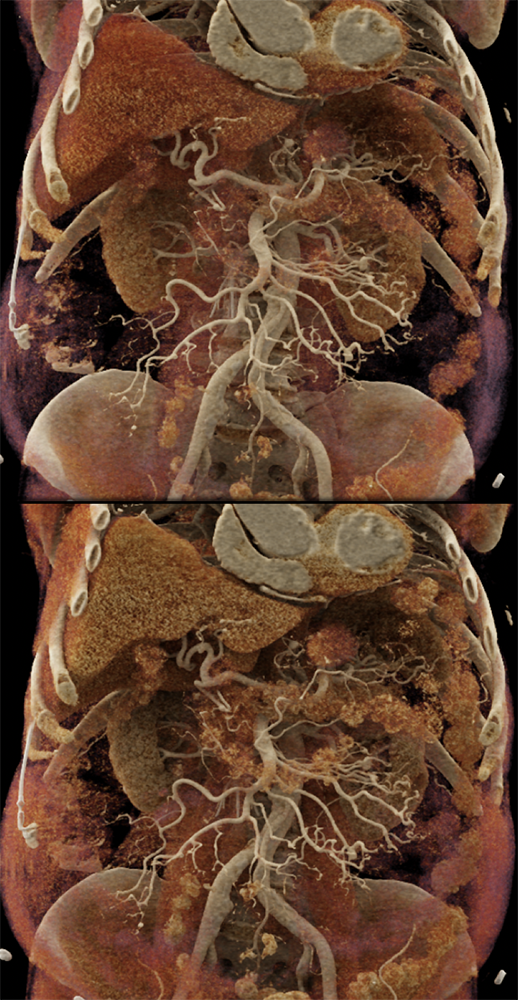 Polyarteritis Nodosa: Vasculitis SMA and Celiac