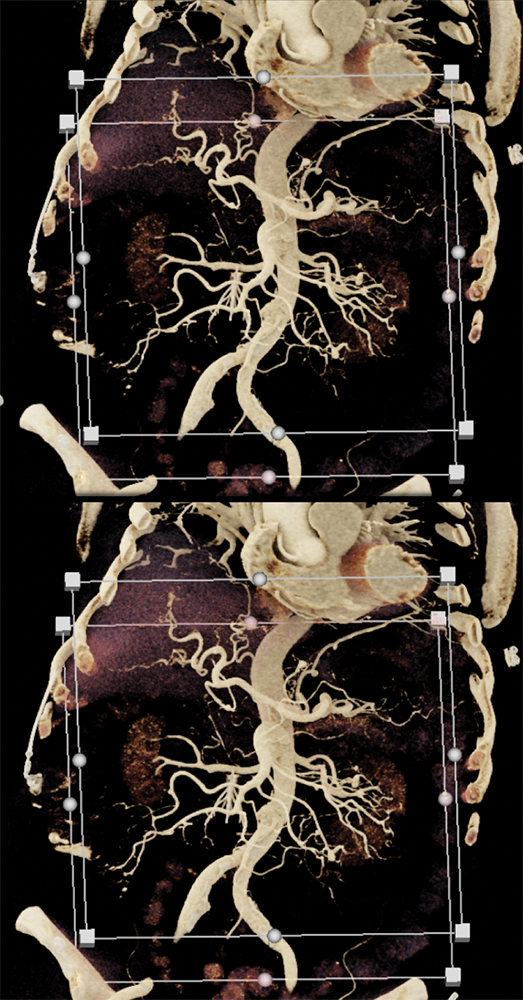 Polyarteritis Nodosa: Vasculitis SMA and Celiac