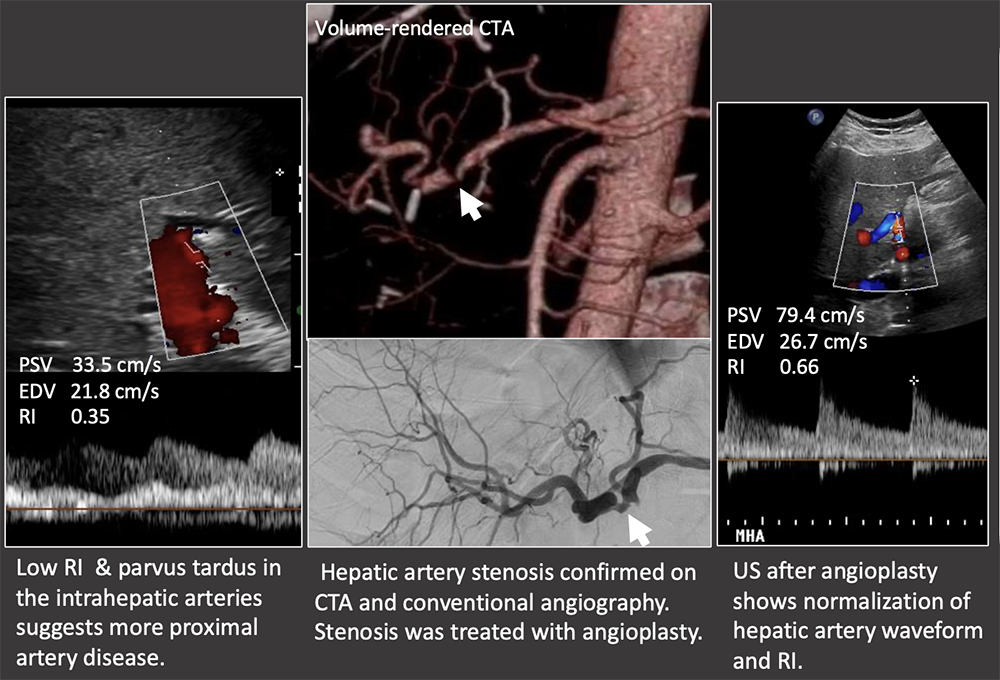 Case: Hepatic Artery Stenosis