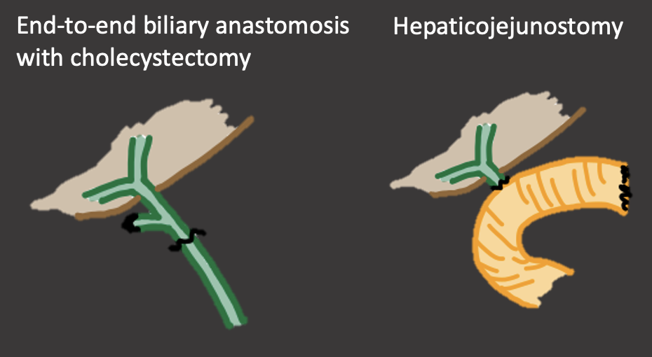 Biliary Anastomosis in OLT
