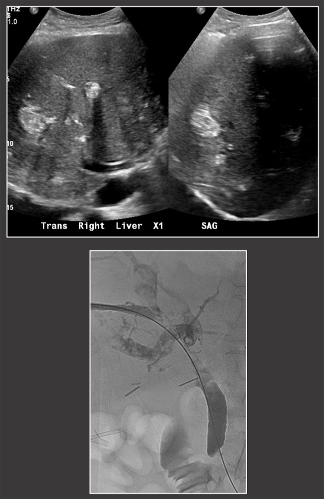 Imaging of Liver Transplants