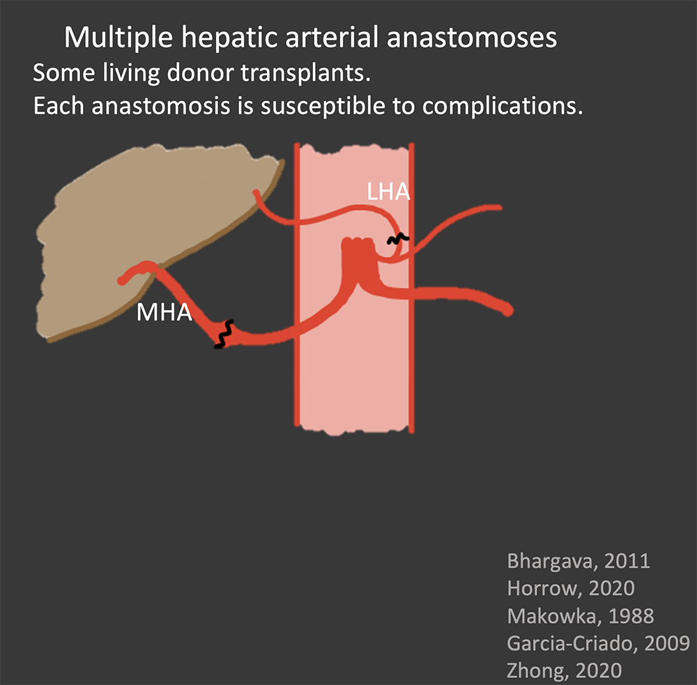 Hepatic Artery Normal Appearance in OLT
