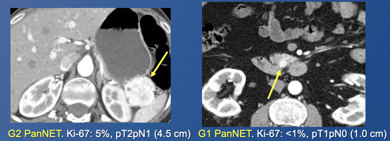 Pancreatic Neuroendocrine Tumors