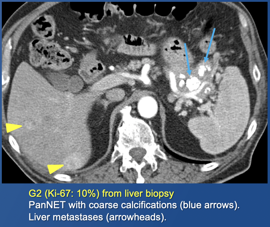 Pancreatic Neuroendocrine Tumors