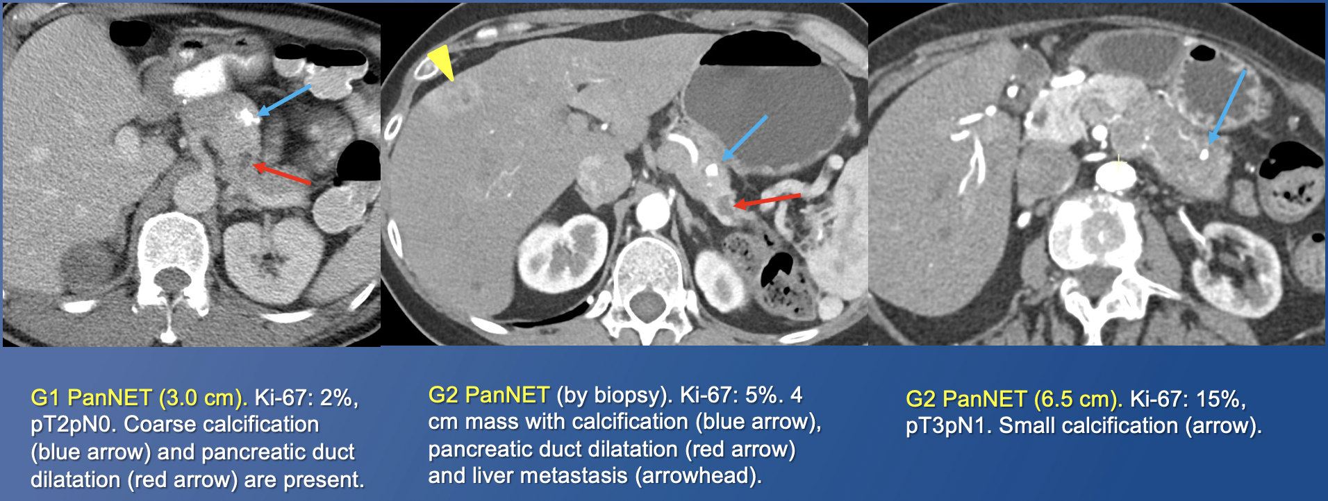 Pancreatic Neuroendocrine Tumors