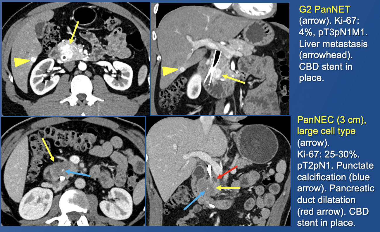 Pancreatic Neuroendocrine Tumors