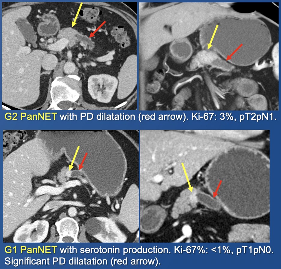 Pancreatic Neuroendocrine Tumors