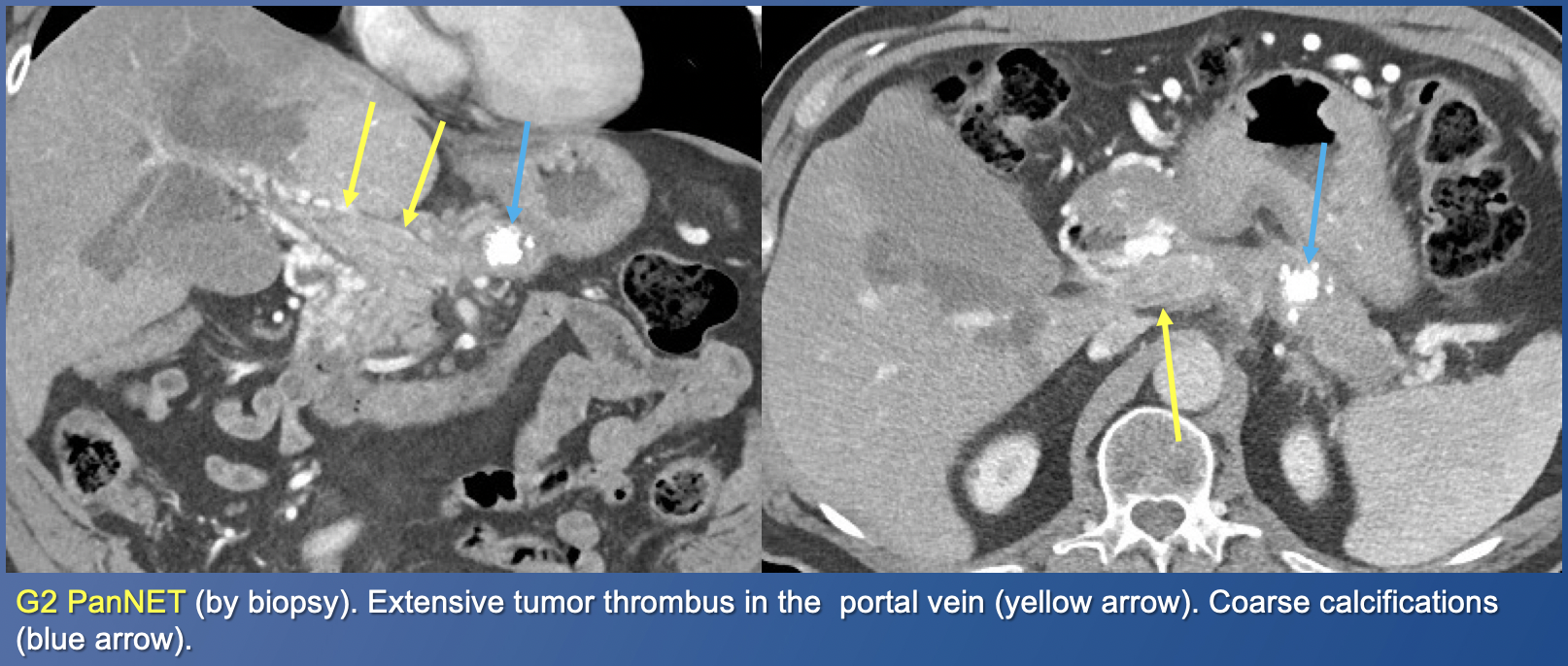 Pancreatic Neuroendocrine Tumors