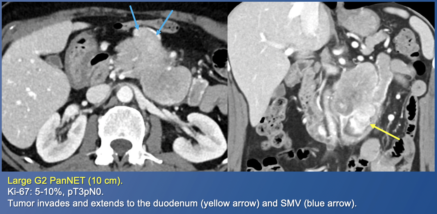 Pancreatic Neuroendocrine Tumors