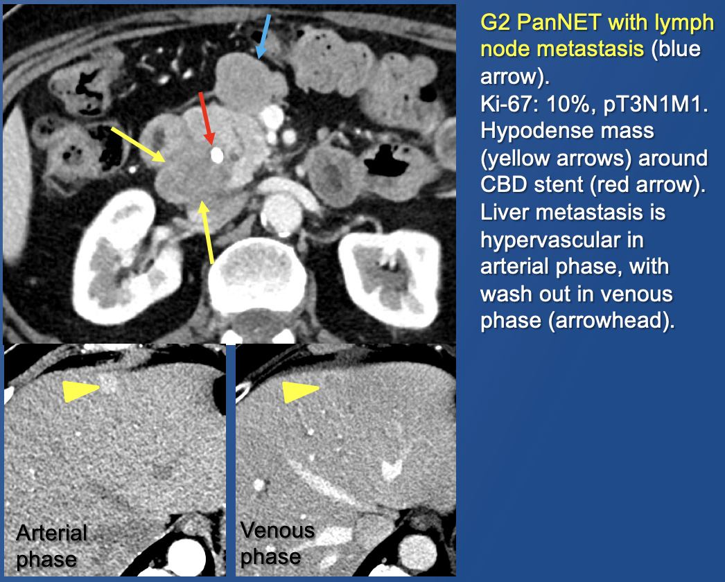 Pancreatic Neuroendocrine Tumors