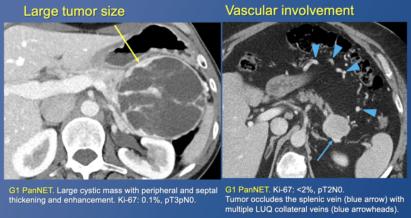 Pancreatic Neuroendocrine Tumors