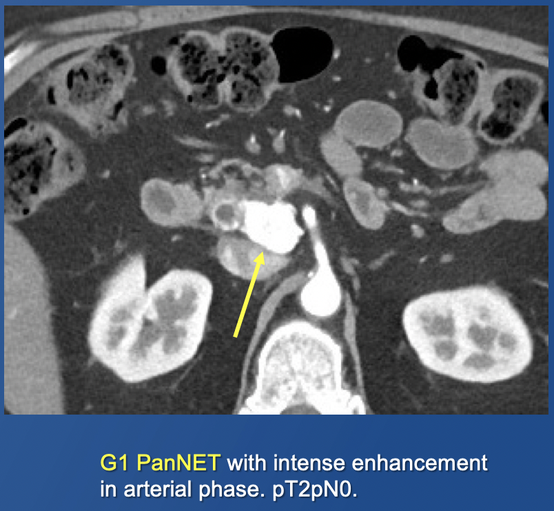 Pancreatic Neuroendocrine Tumors