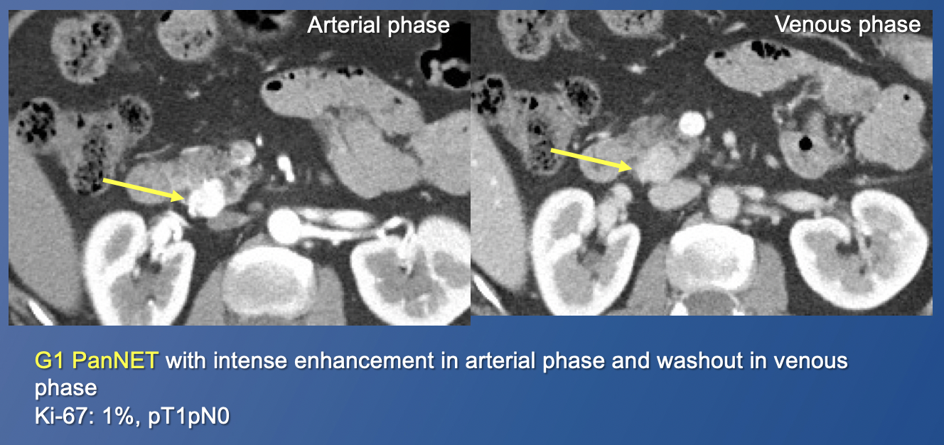 Pancreatic Neuroendocrine Tumors