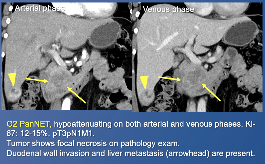 Pancreatic Neuroendocrine Tumors