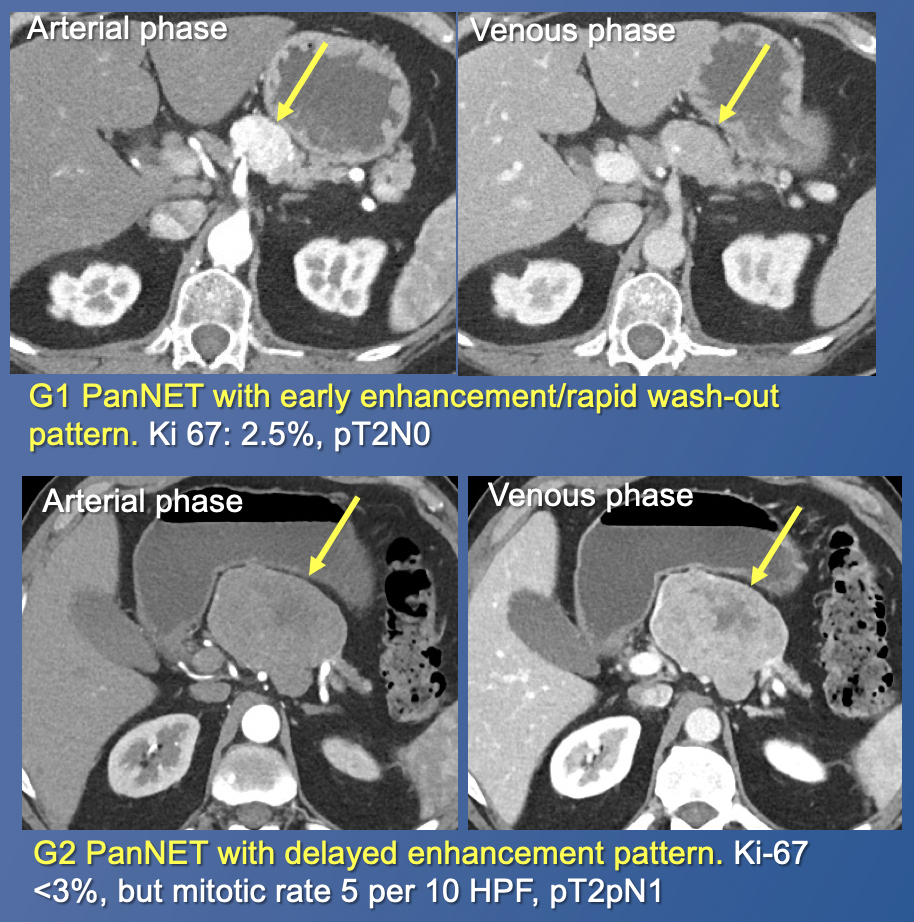 Pancreatic Neuroendocrine Tumors