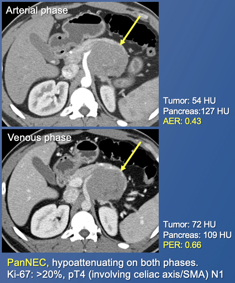 Pancreatic Neuroendocrine Tumors