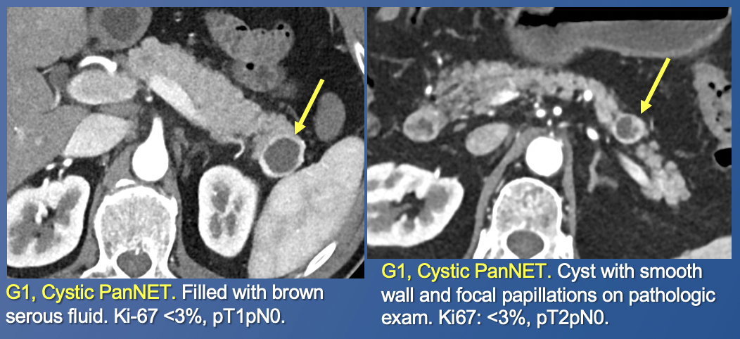 Pancreatic Neuroendocrine Tumors