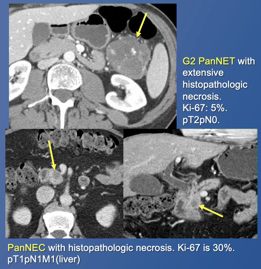 Pancreatic Neuroendocrine Tumors