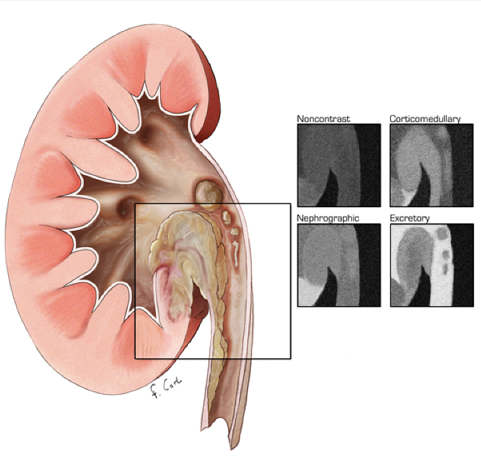 Renal Transitional Cell Carcinoma