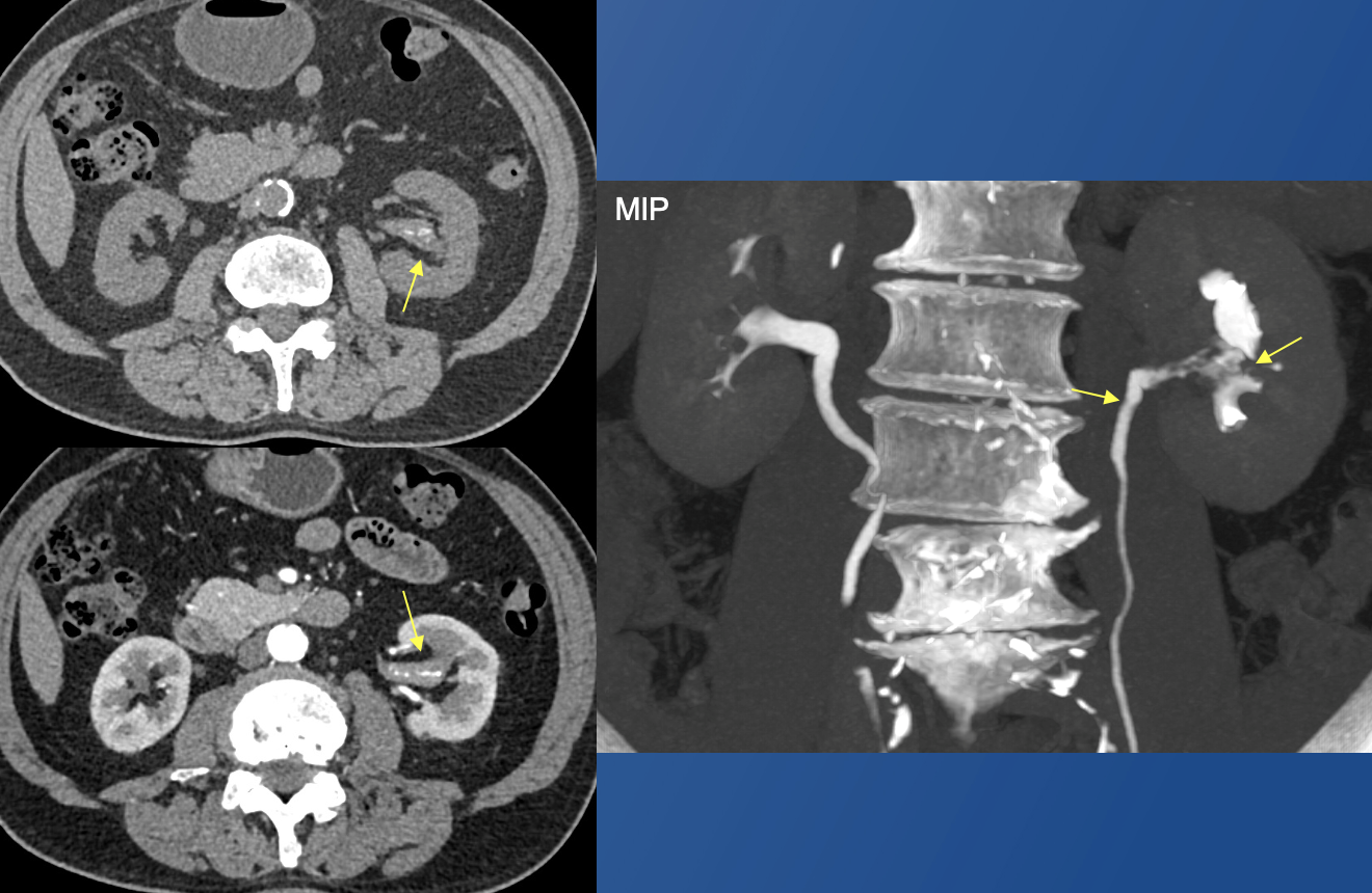 Renal Transitional Cell Carcinoma
