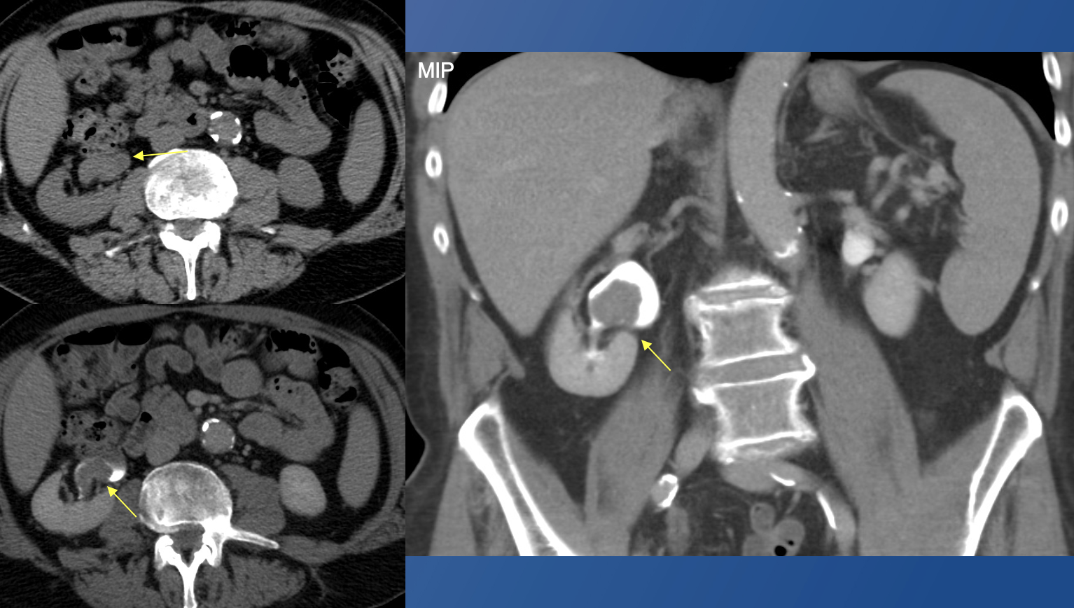 Renal Transitional Cell Carcinoma