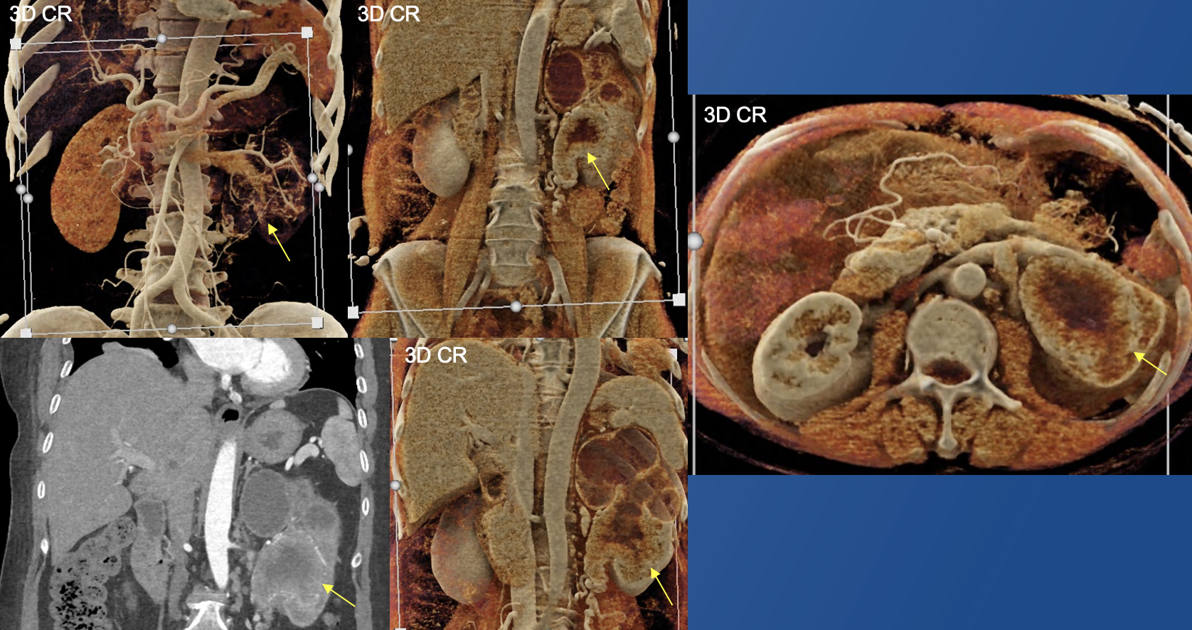 Renal Transitional Cell Carcinoma