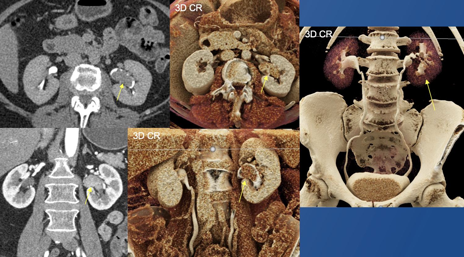 Renal Transitional Cell Carcinoma