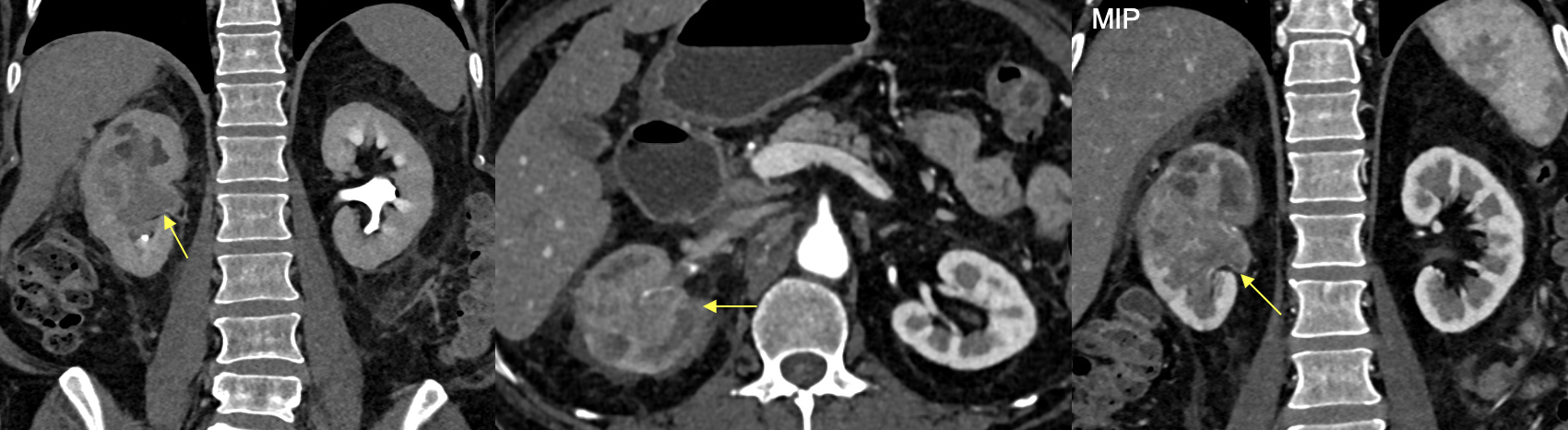 Renal Transitional Cell Carcinoma