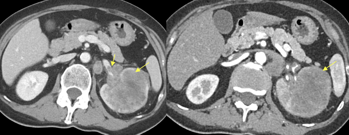 Renal Transitional Cell Carcinoma