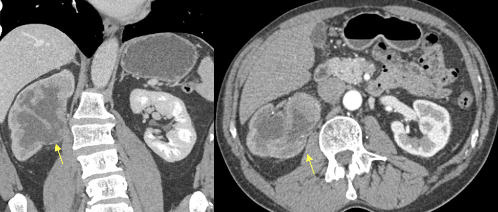 Renal Transitional Cell Carcinoma