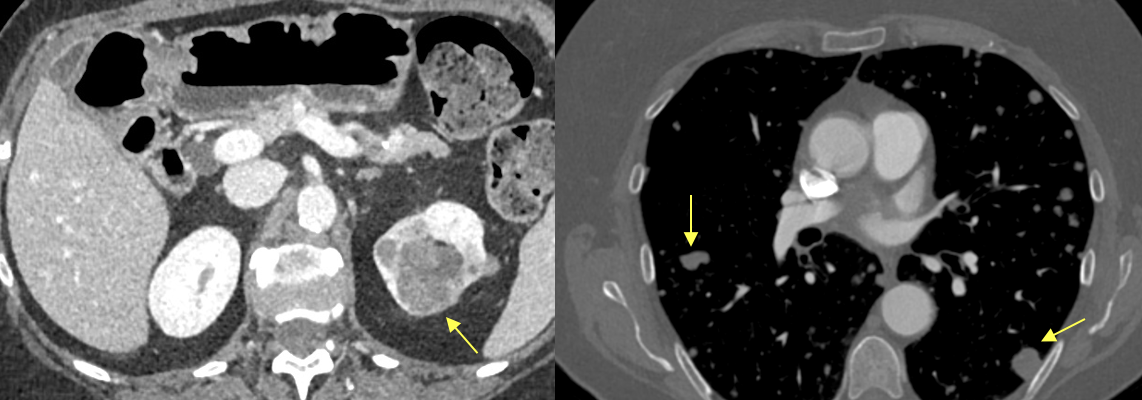 Renal Transitional Cell Carcinoma