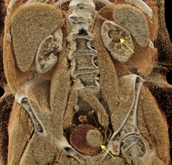 Renal Transitional Cell Carcinoma