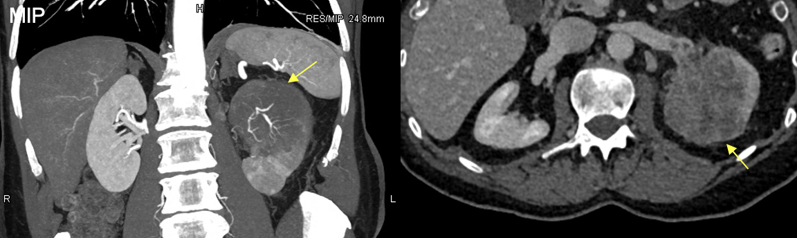 Renal Transitional Cell Carcinoma