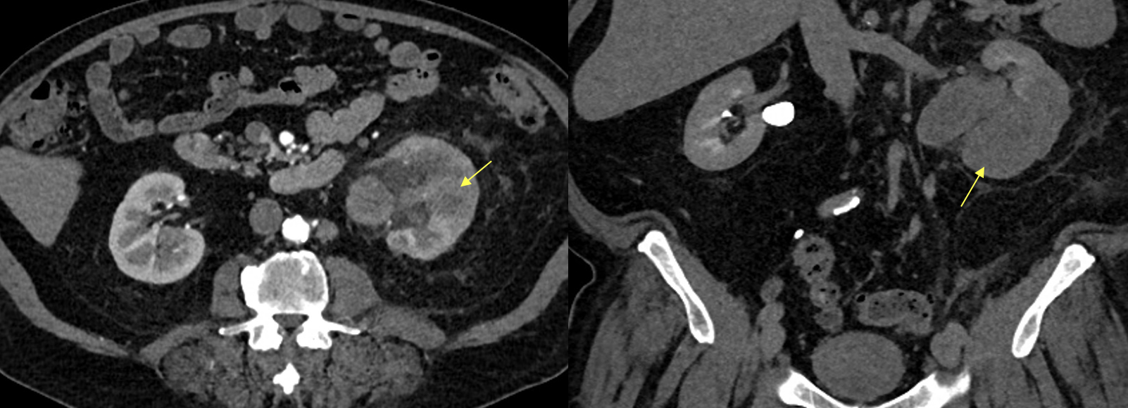 Renal Transitional Cell Carcinoma