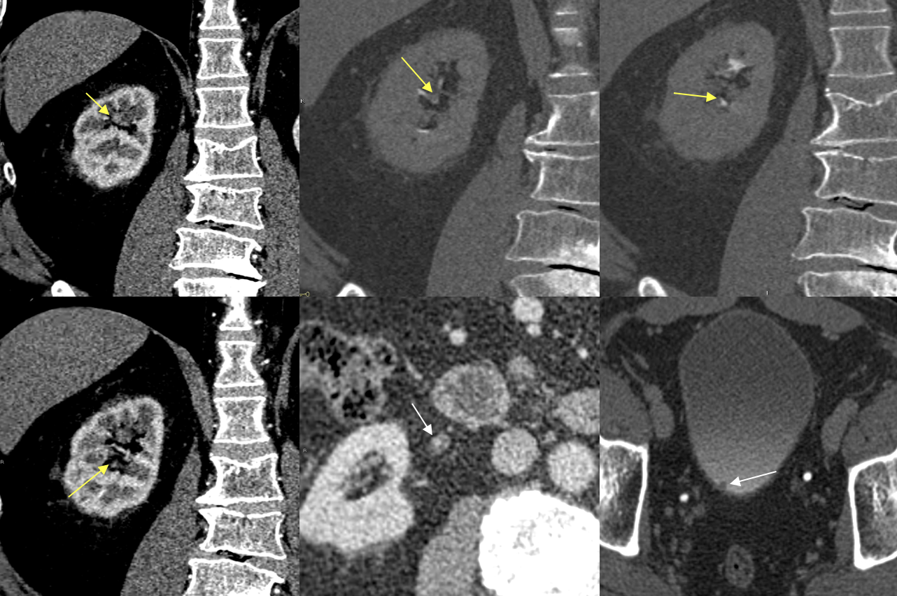 Renal Transitional Cell Carcinoma