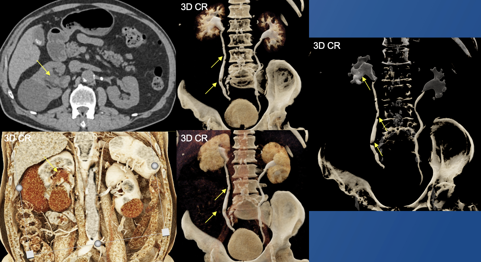 Renal Transitional Cell Carcinoma