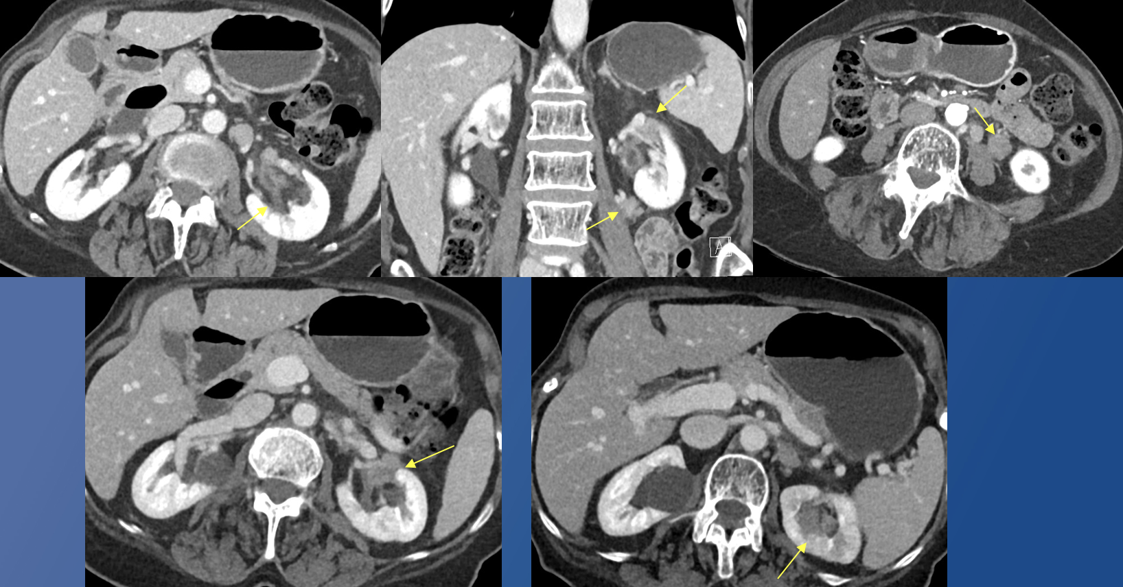 Renal Transitional Cell Carcinoma
